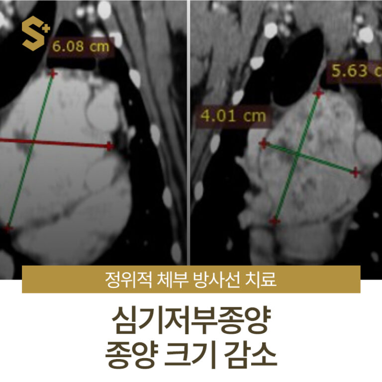 강아지 심장종양 방사선치료, 약 3개월 치료 과정 _ 심기저부종양 종양크기 감소 케이스 살펴보기 – 양산 에스 동물암센터