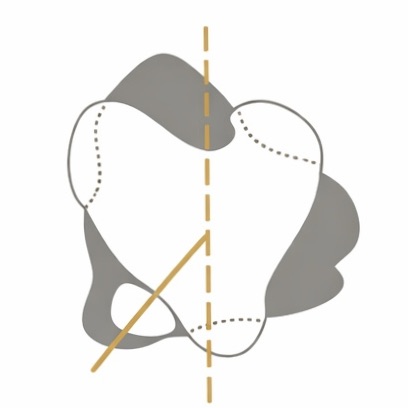 슬개골 탈구 3기