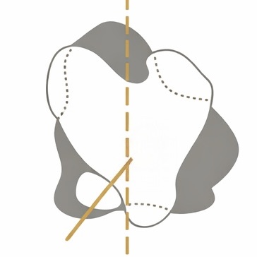 슬개골 탈구 2기