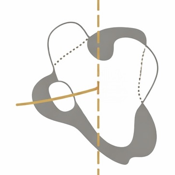슬개골 탈구 4기