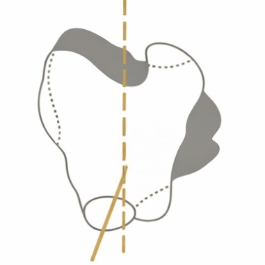 슬개골 탈구 1기