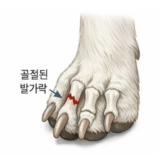 발가락 골절