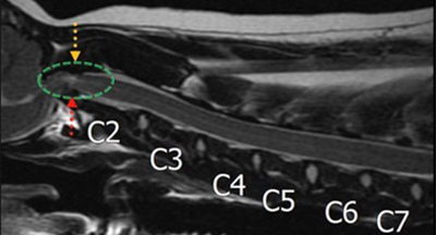 환축추 아탈구 영상 또는 수술 이미지