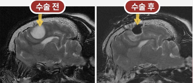 뇌수술 전후 MRI 비교 이미지