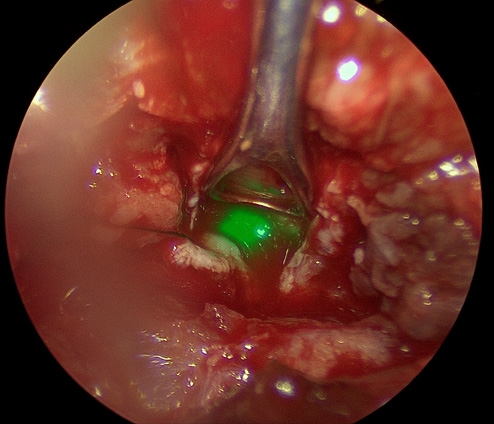 ICG 형광 확인 이미지