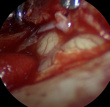 ICG 염색 수술 이미지
