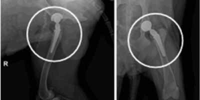 인공 고관절 치환술 수술 후
