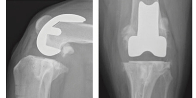 인공 무릎관절 치환술 수술 후