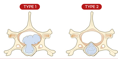 디스크의 종류 이미지