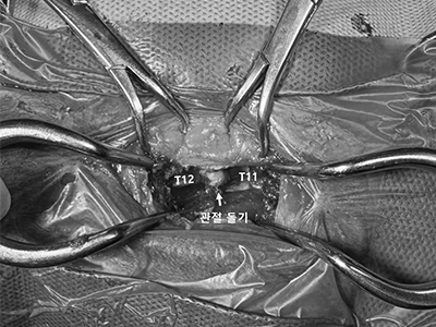 디스크 수술 이미지 1