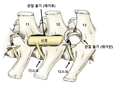디스크 수술 이미지 2