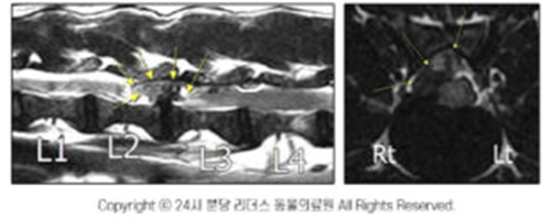 흉요추 디스크 정밀 진단 이미지