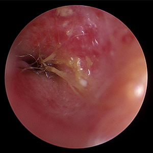 이도 이물 제거 예시 이미지