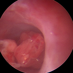방광 폴립 예시 이미지