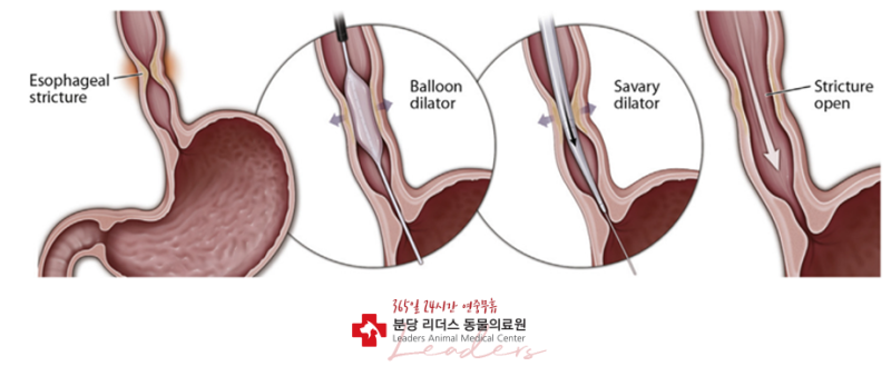 풍선확장술 시술 이미지