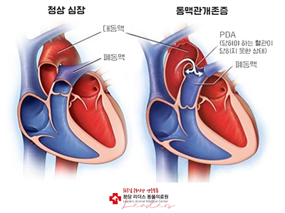 동맥관개존증(PDA) 모식도