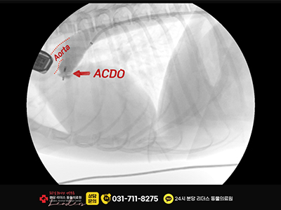 ACDO 시술 후 영상
