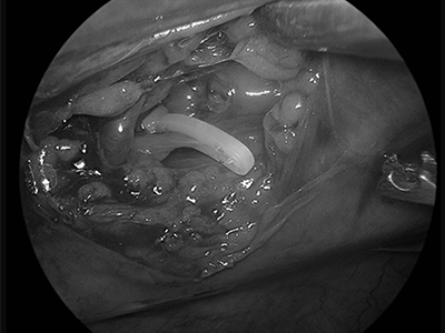흉강경 수술 장면 이미지