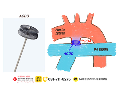 ACDO 기구 및 위치 설명 이미지