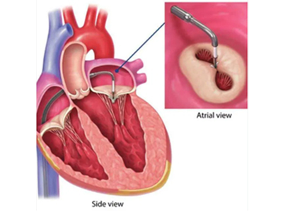V-Clamp 모식도 이미지 2