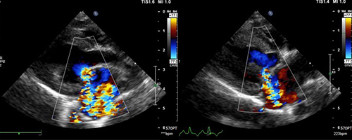 수술 전/후 초음파 이미지