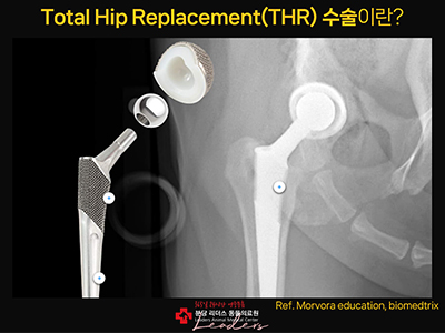 인공관절 참고 이미지