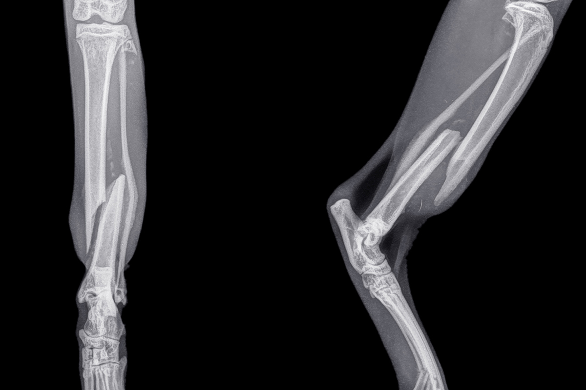 대퇴골두절제술 FHO 수술 이미지