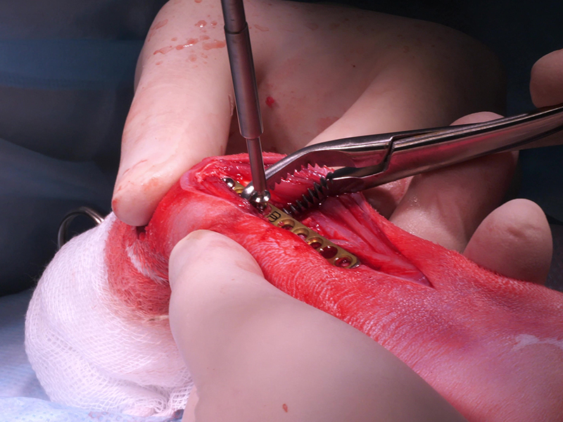 핀플레이트 고정술