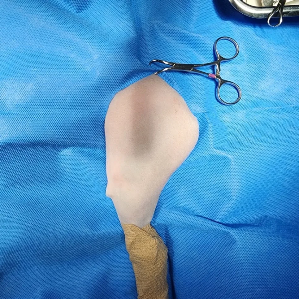 대퇴골두절제술 수술 중 사진