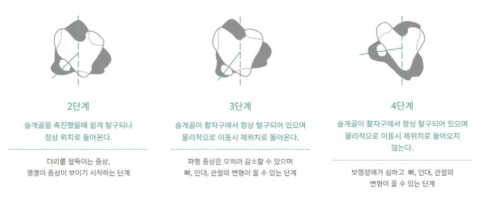 슬개골 탈구 2기·3기·4기 단계별 설명