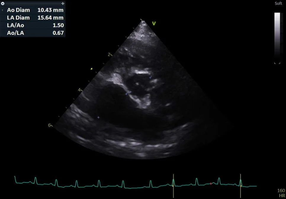 좌심방과 대동맥 비율을 잰 심장 초음파