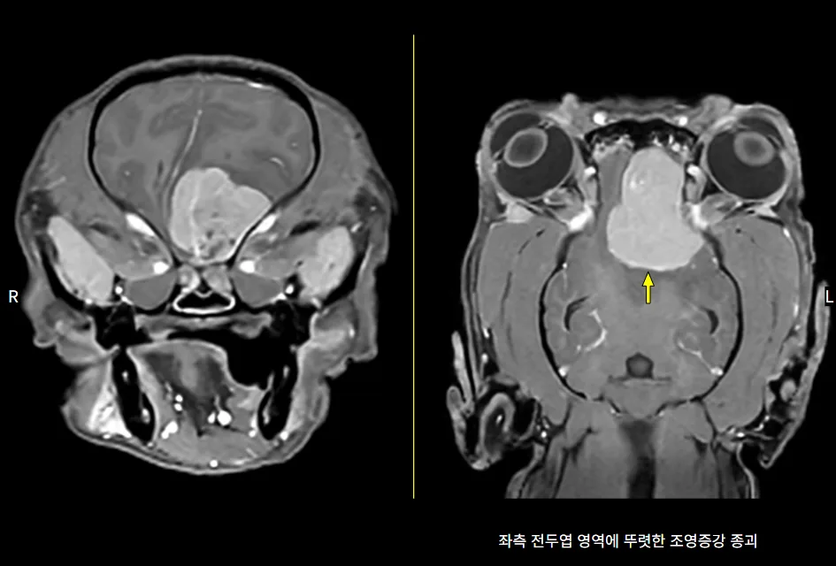 좌측 전두엽 종괴가 보이는 뇌 MRI