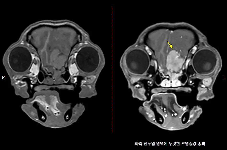 좌측 전두엽 종괴가 보이는 뇌 MRI 다른 단면