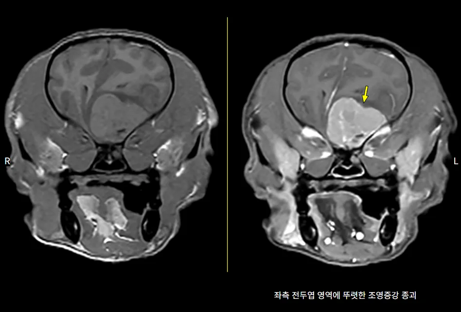 좌측 전두엽 종괴가 보이는 뇌 MRI 횡단면
