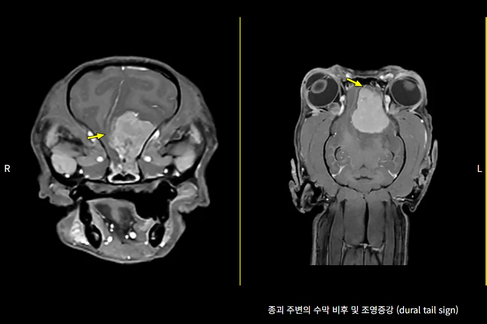 종괴 주변 경막 꼬리 징후가 보이는 뇌 MRI