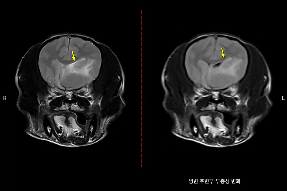 종괴 주변 부종이 보이는 뇌 MRI