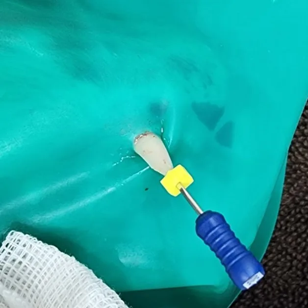 러버댐을 씌우고 신경치료를 하는 송곳니