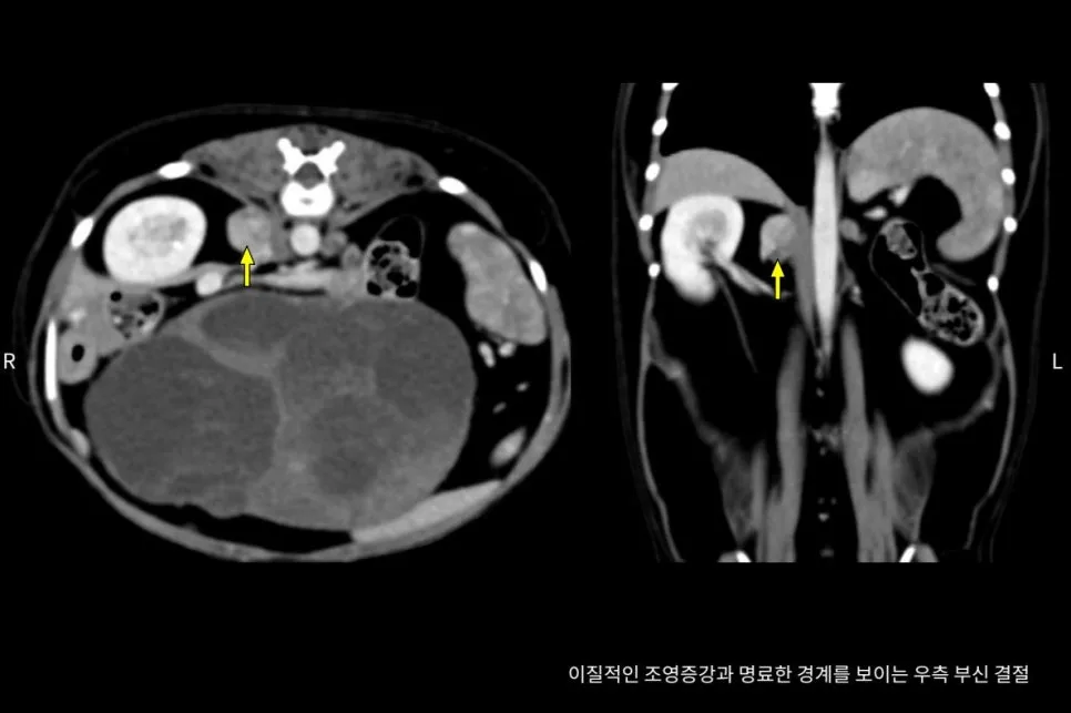 복부 CT 횡단면과 관상면
