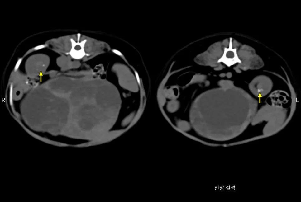 복부 CT 횡단면