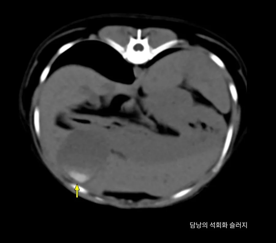 담낭이 보이는 복부 CT