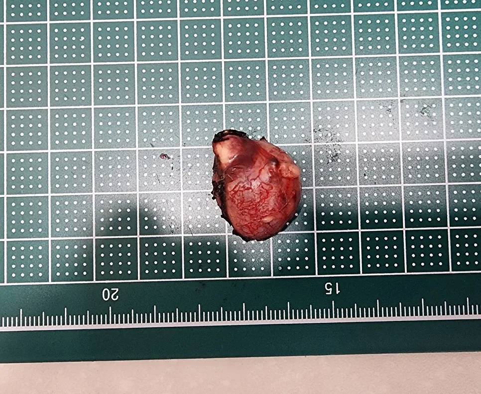 제거한 부신 종양