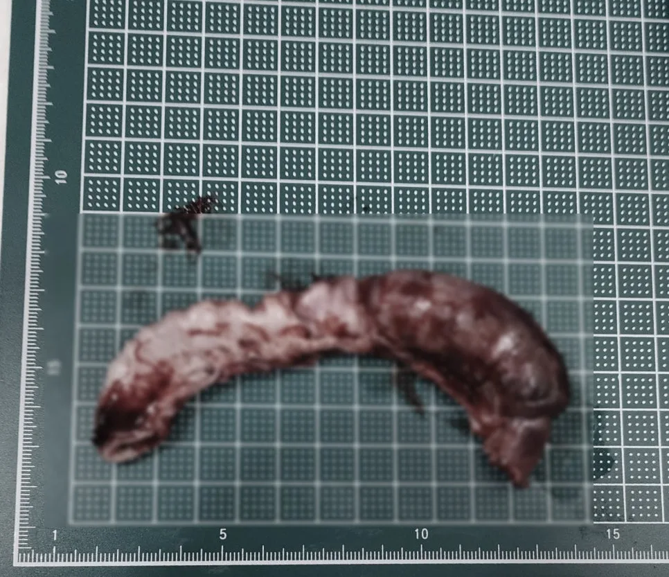 절제한 장